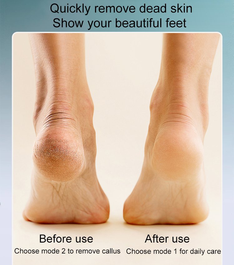 🔥Hot Sale - 45% OFF💕Rechargeable Electric Foot Callus Remover